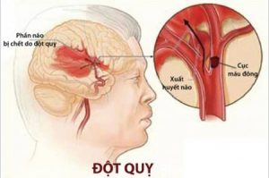dau-hieu-dot-quy