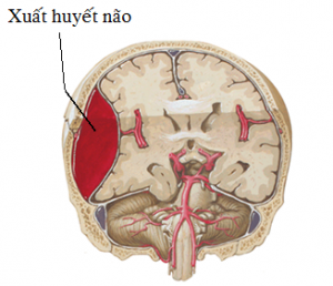 cham-soc-benh-nhan-xuat-huyet-nao