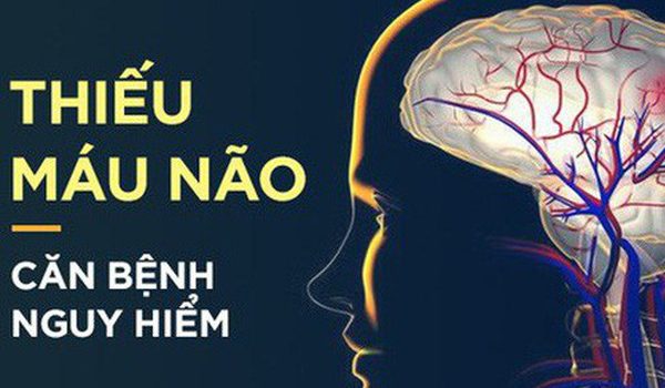 Dấu hiệu điển hình của bệnh thiếu máu não: Hãy cảnh giác sớm để tránh bị đột quỵ bất ngờ Dấu hiệu điển hình của bệnh thiếu máu não: Hãy cảnh giác sớm để tránh bị đột quỵ bất ngờ