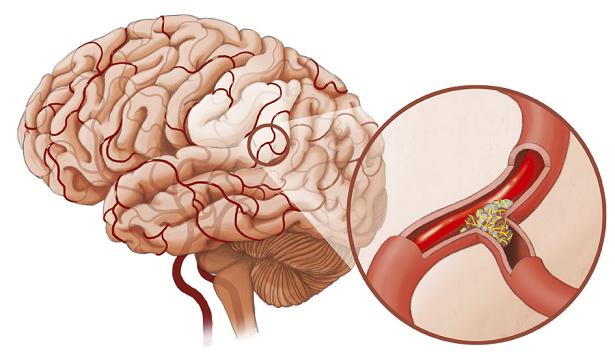Các giai đoạn của bệnh tai biến mạch máu não
