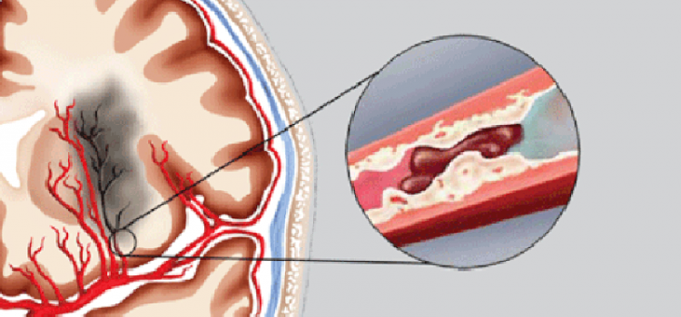 Nguyên nhân nhồi máu não là gì? Nguyên nhân nhồi máu não là gì?