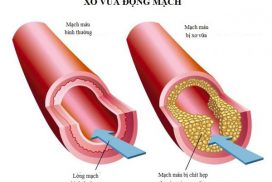 xo-vua-dong-mach-nguyen-nhan-chinh-gay-dot-quy