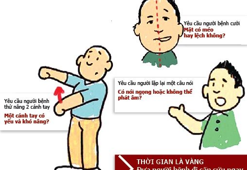 Nhận biết nhanh 4 dấu hiệu này, 90% người bị đột quỵ có thể thoát khỏi lưỡi hái tử thần Nhận biết nhanh 4 dấu hiệu này, 90% người bị đột quỵ có thể thoát khỏi lưỡi hái tử thần