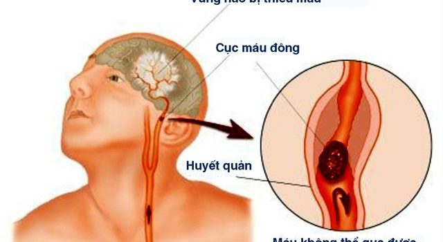 Triệu chứng của bệnh nhồi máu não Triệu chứng của bệnh nhồi máu não
