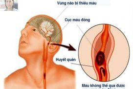 nhoi-mau-nao