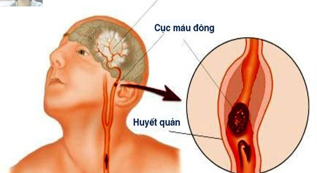 Nguyên nhân, triệu chứng, cách phòng ngừa và điều trị bệnh nhồi máu não Nguyên nhân, triệu chứng, cách phòng ngừa và điều trị bệnh nhồi máu não