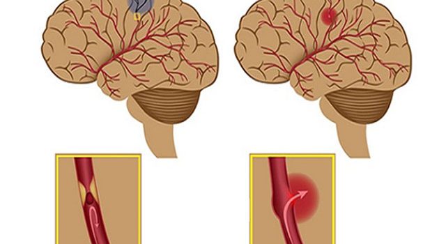 3 Nguyên nhân cơ bản gây tai biến mạch máu não 3 Nguyên nhân cơ bản gây tai biến mạch máu não