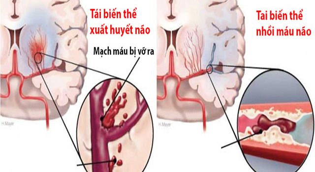 Giải pháp điều trị tai biến mạch máu não tốt nhất cho người bệnh Giải pháp điều trị tai biến mạch máu não tốt nhất cho người bệnh