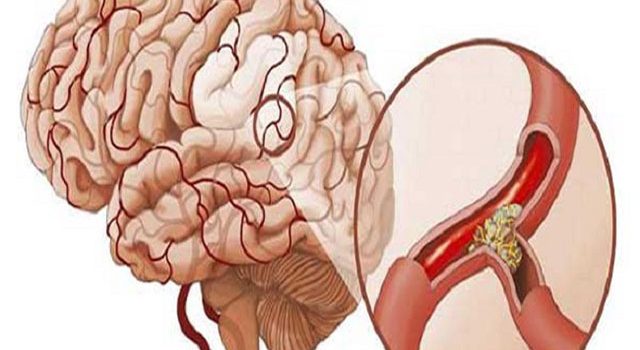 Chế độ dinh dưỡng tốt cho sức khỏe người bị nhồi máu não Chế độ dinh dưỡng tốt cho sức khỏe người bị nhồi máu não