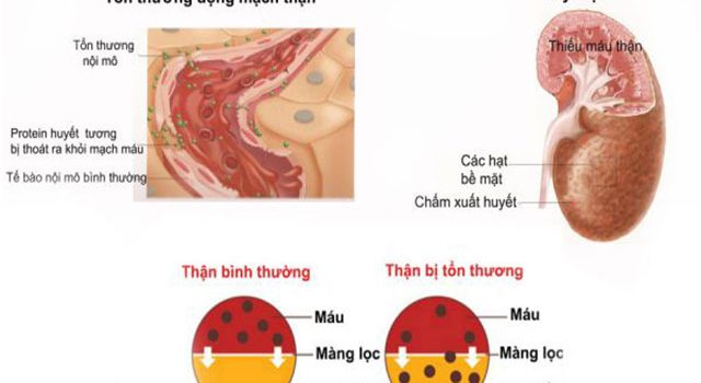 3 lời khuyên hữu ích giúp người cao huyết áp cả đời không lo suy thận 3 lời khuyên hữu ích giúp người cao huyết áp cả đời không lo suy thận