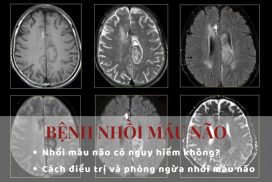 Bệnh nhồi máu não và 4 điều cơ bản cần phải biết