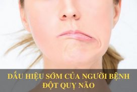 Cách phát hiện đột quỵ não từ sớm để cấp cứu kịp thời