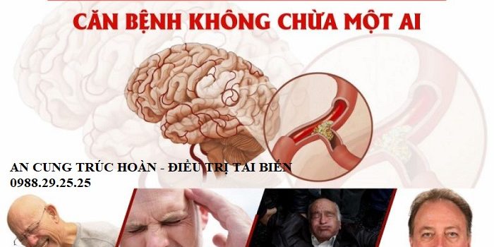 Nguyên nhân gây nên tai biến mạch máu não Nguyên nhân gây nên tai biến mạch máu não