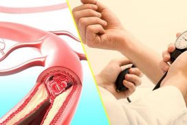 huyết áp cao biến chứng não