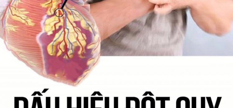 Những dấu hiệu đột quỵ não trước 30 ngày đừng bỏ qua Những dấu hiệu đột quỵ não trước 30 ngày đừng bỏ qua