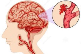 xuất huyết não là gì