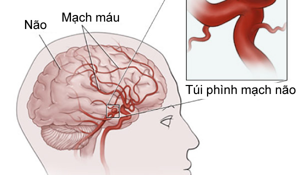 Những bệnh lý làm tăng nguy cơ đột quỵ Những bệnh lý làm tăng nguy cơ đột quỵ
